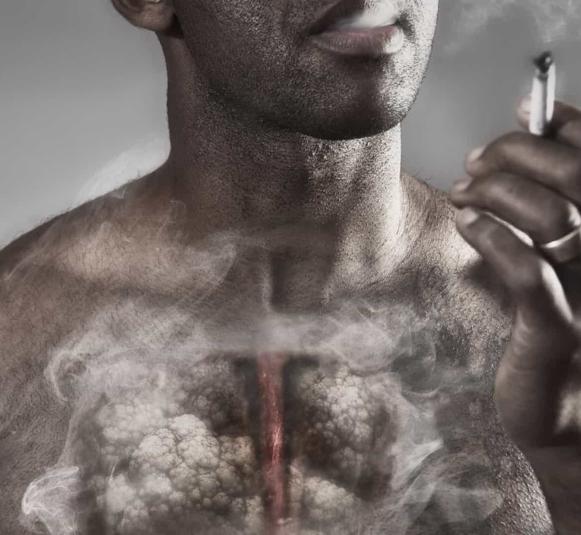 CANCRO DO PULMÃO: QUAL O TRATAMENTO?